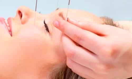 acupuntura estetica